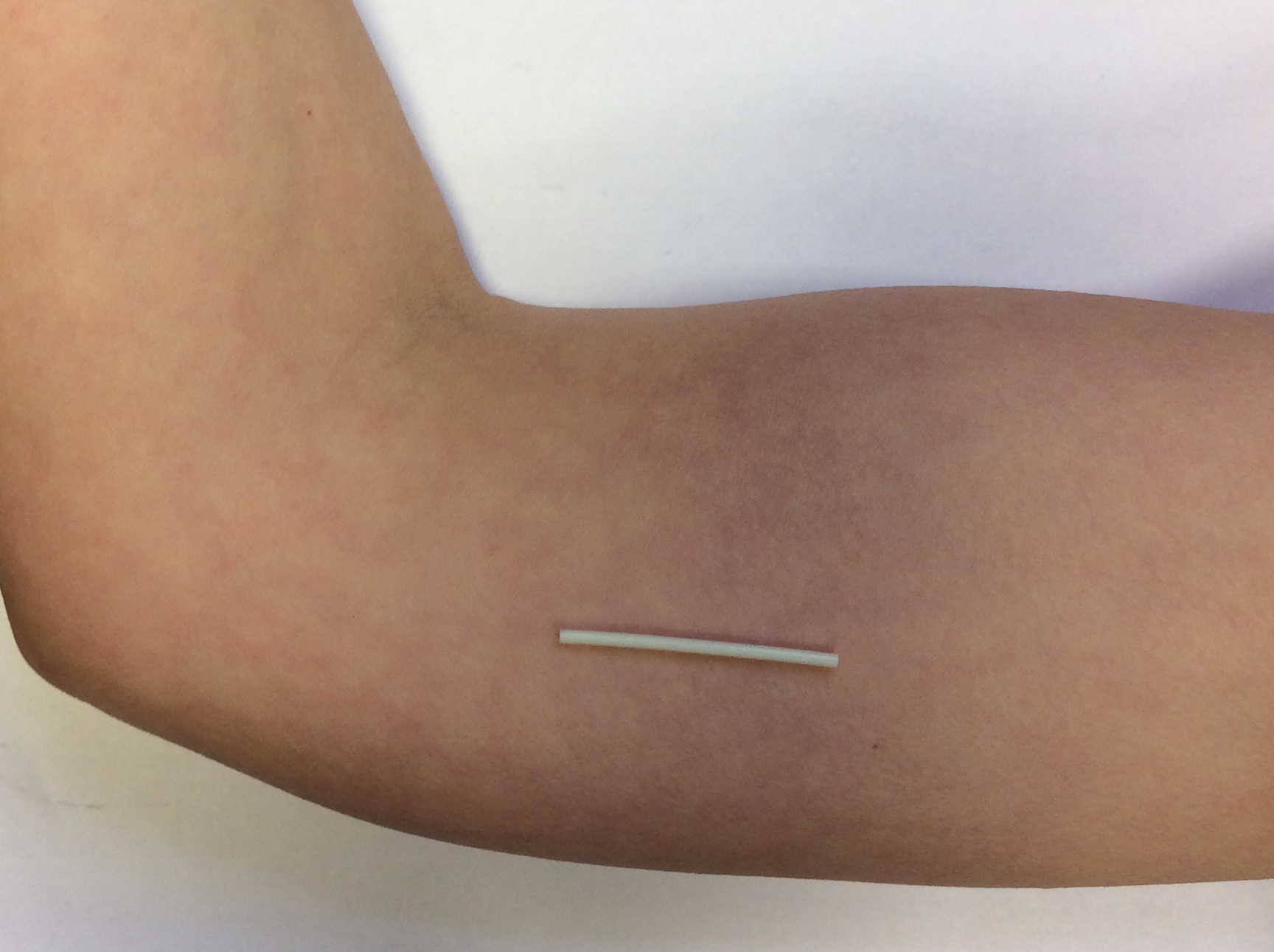 sexual-health-young-people-the-contraceptive-implant